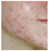 acne scars before