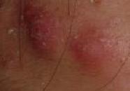 cystic acne