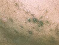 acne pigment spots